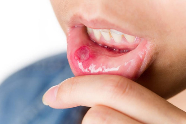 bệnh răng miệng phổ biến