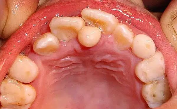 các bệnh về răng