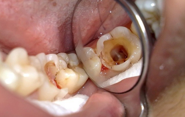 các bệnh về răng miệng