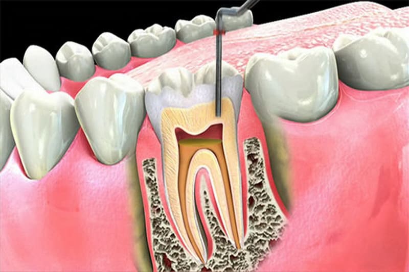 cách chữa viêm tủy răng