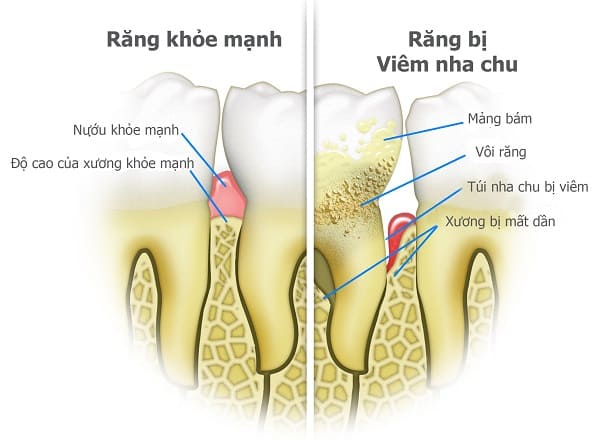 so sánh viêm nha chu và răng thường