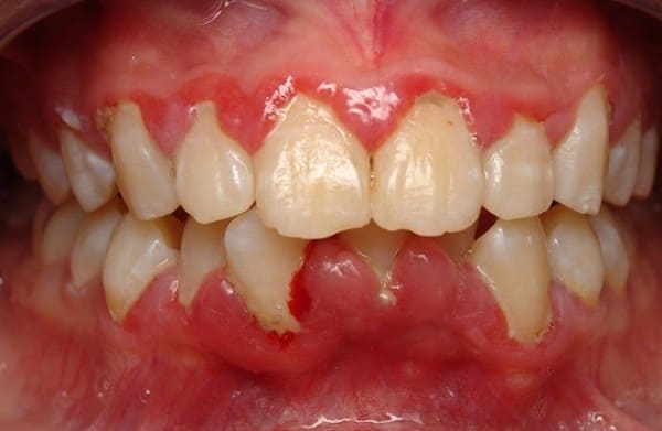 viêm chân răng là gì