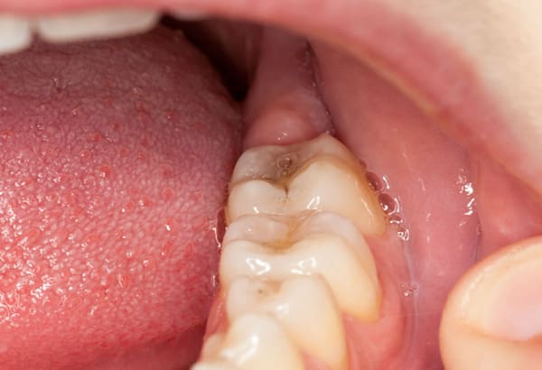 viêm lợi trùm răng