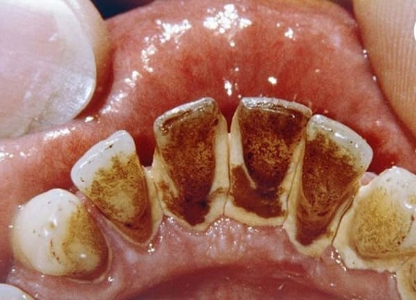 răng bị mảng bám đen